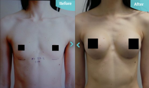 Before and after Breast Augmentation at The Private Clinic.