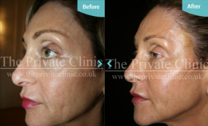 Before and after fat transfer to the face results_ performed by Dr Dennis Wolf at The Private Clinic