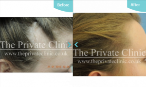 Before and after Hair Transplantation at The Private Clinic. 