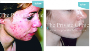 Before and after shots of our acne treatment at The Private Clinic.