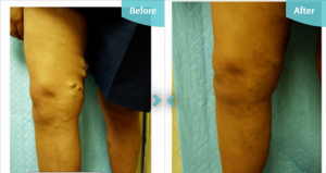 Before and after EVLA treatment at The Private Clinic