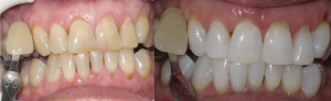 Before and After Dr. Wyman Chan's teeth whitening treatment