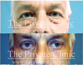 Blepharoplasty eyelid surgery male before and after photo
