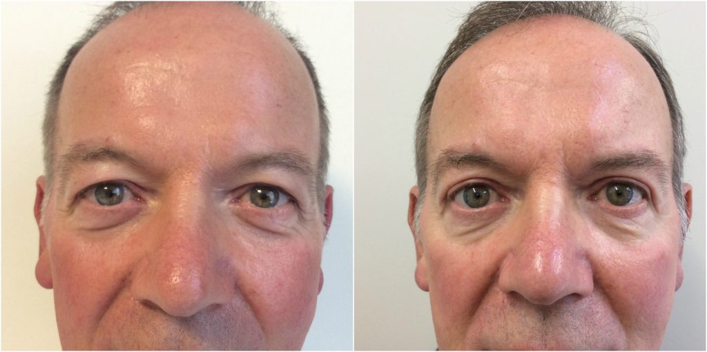 Before and after Upper Blepharoplasty with Dr Davood Fallahdar. 