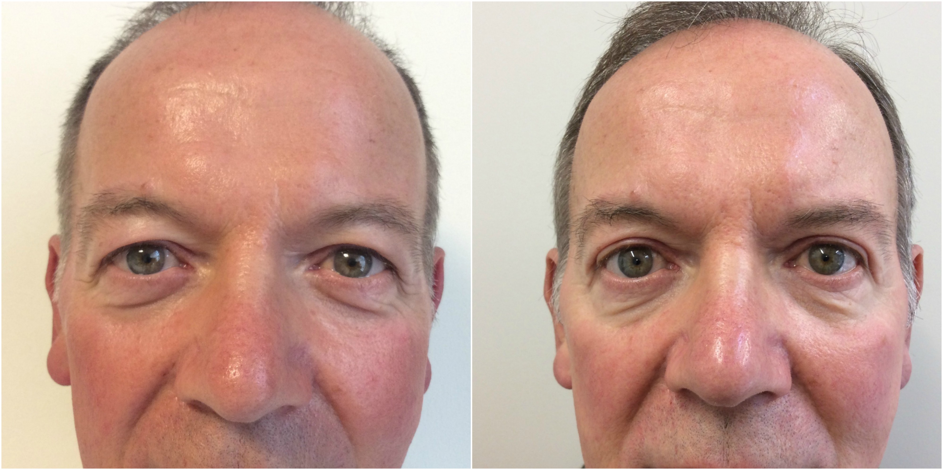 Blepharoplasty - An Overview