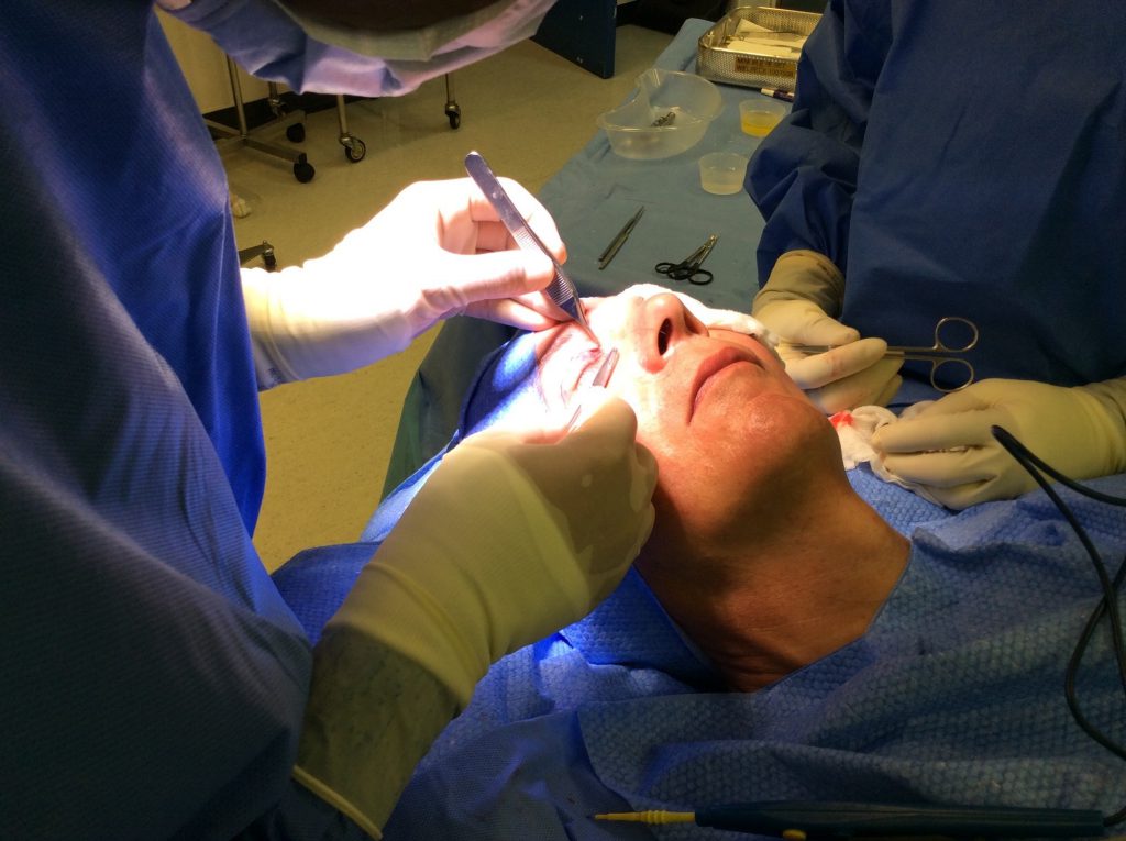 Patient before his Upper Blepharoplasty with Dr Fallahdar.