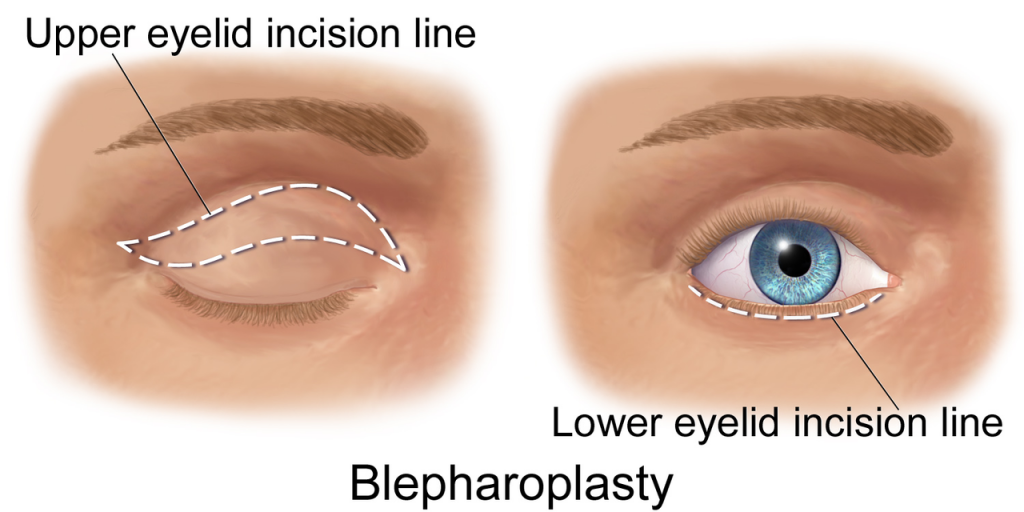 blepharoplasty upper lower eyelid surgery incision line