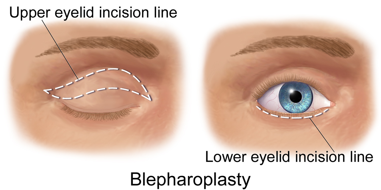 What are some cosmetic surgery options for eye bags?