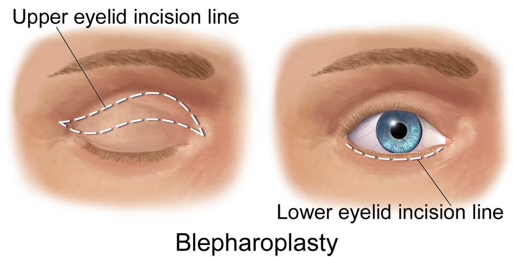 eyelid surgery blepharoplasty incison line