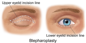 blapharoplasty upper lower eyelid incision line areas