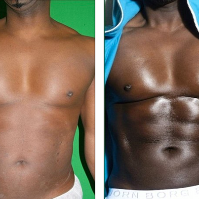Before and After VASER Lipo