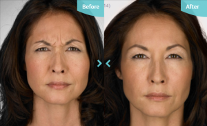 Before and after image of wrinkle injections.