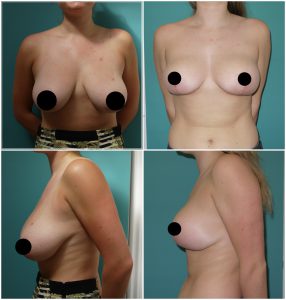 Before and after Breast Reduction at The Private Clinic.