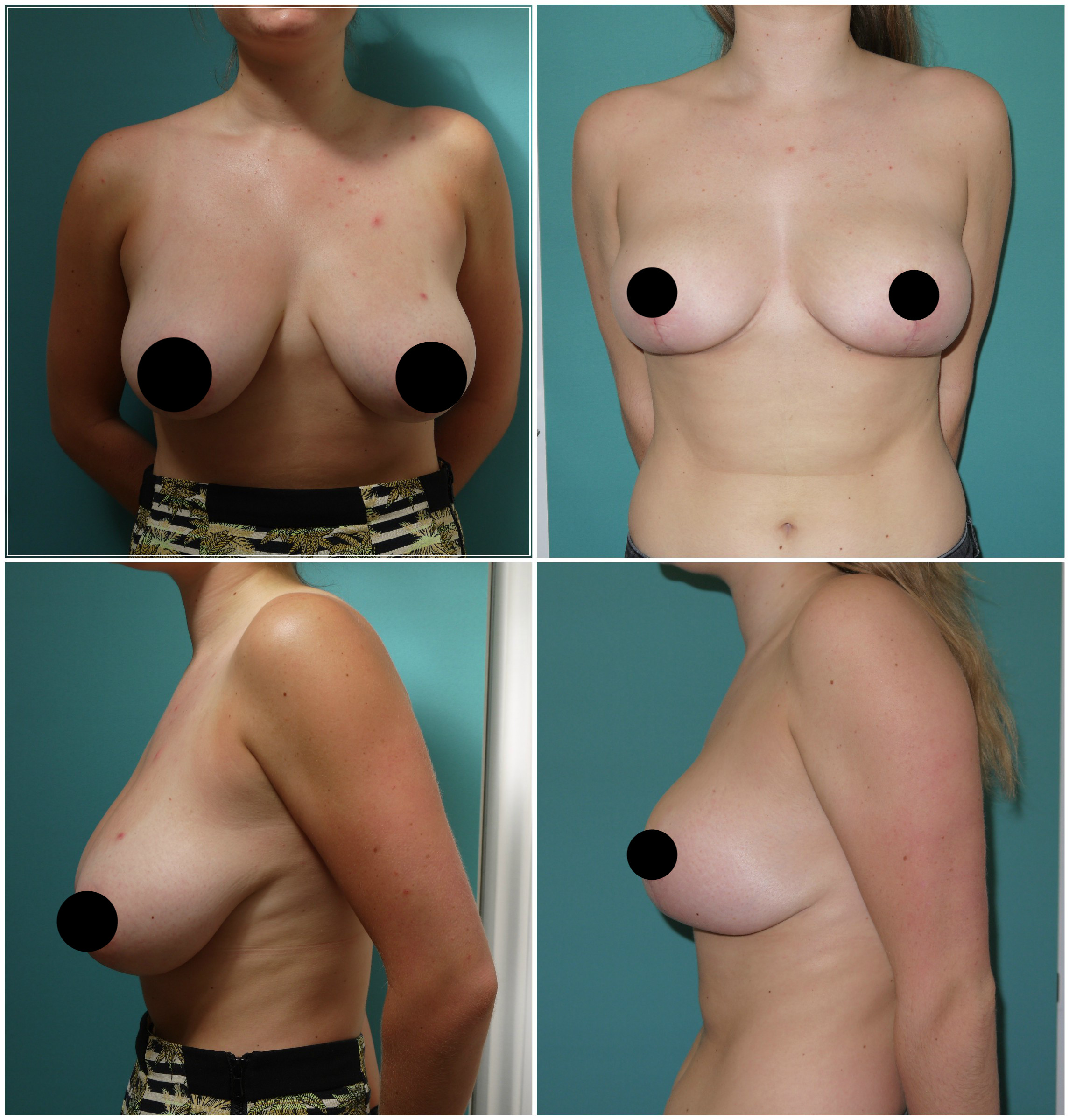 Breast Enlargement Implants In Manchester