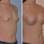 Breast augmentation before and after the private clinic