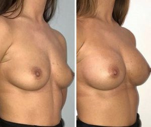 breast implant natural shape before after photo