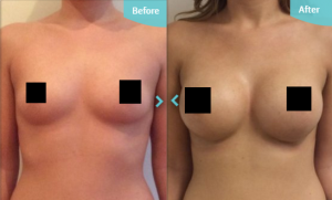 Before and after Breast Implants at The Private Clinic, performed by Mr. Davood Fallahdar