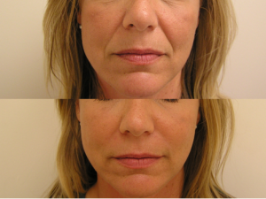 Dermal fillers naso-labial folds before and after photo 