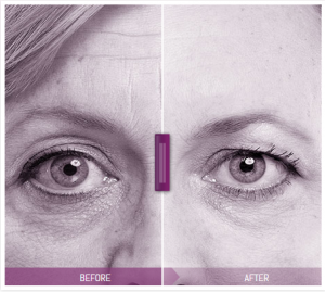 Example of before and after the use of Juvederm Dermal Fillers. 