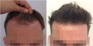 FUE Hair Transplant Before After Dr Mouzakis The Private Clinic