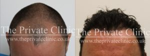 Before and After Advanced FUE Hair Transplant by Dr Raghu Reddy at The Private Clinic.