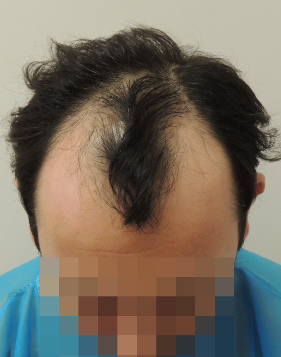 Natural Hair Restoration Techniques Natural Hair Restoration Techniques