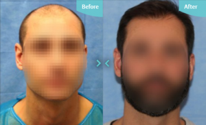 Hair Transplantation can help restore areas that have been lost, but it can't stop you losing more hair which is why we are so strict on the procedures we perform.