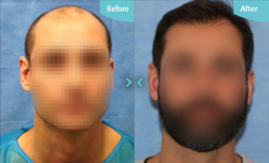 Hair Transplantation can help restore areas that have been lost, but it can't stop you losing more hair which is why we are so strict on the procedures we perform. 