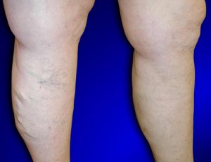 varicose veins before after results
