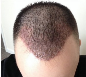 Four days after hair transplant treatment