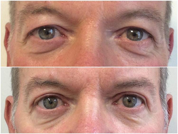 Remove Bags Under The Eye: Comparing Eyelid Surgery vs Eye Fillers