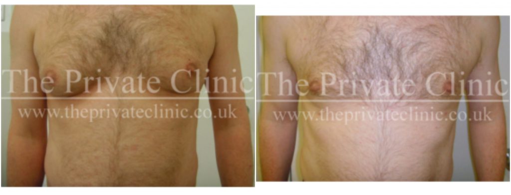 Micro Lipo Treatment