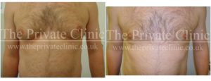 Gynecomastia Micro Lipo Treatment before after photo