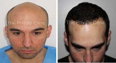 FUE Hair Transplant at The Private Clinic of Harley Street.