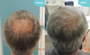 Hair Transplants Before and After Results Crown of head