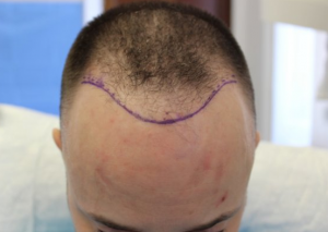 Hairline design transplant results before transplantation