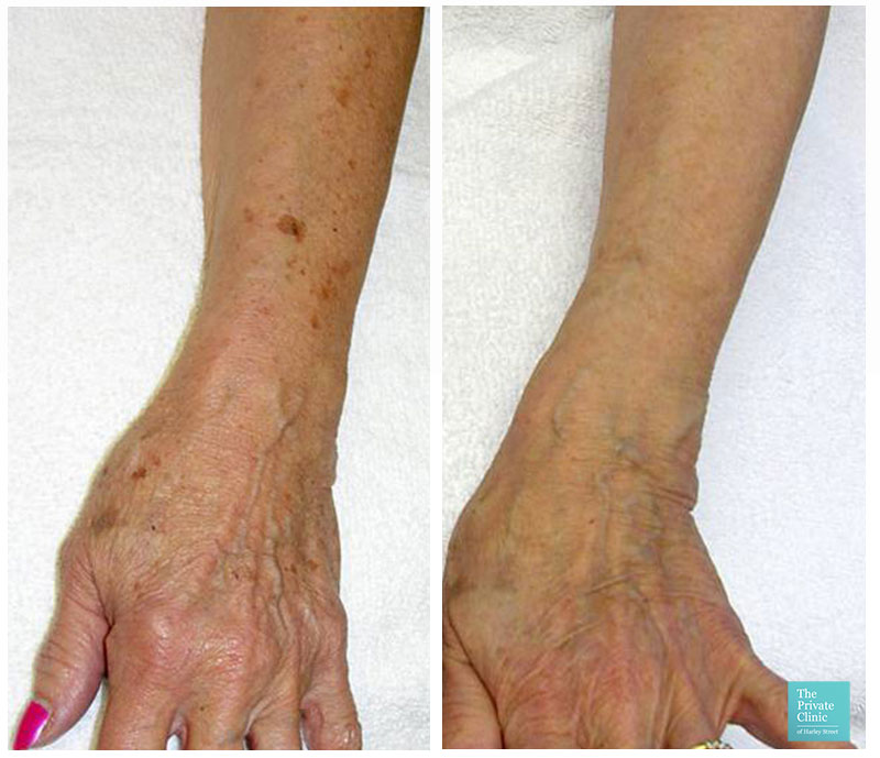 IPL Photorejuvenation hands before after photo