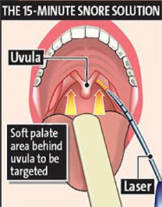 Snoring LAUP treatment 