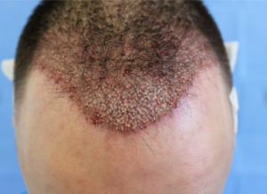 Immediately after hair transplantation to the area