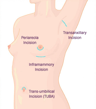 3 Types Of Breast Augmentation Incisions