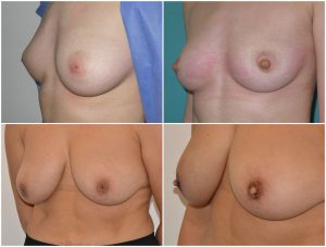 Inverted Nipple treatment Before After photos Private Clinic