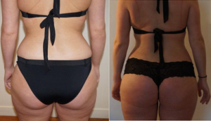 bra fat liposuction before after photo