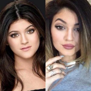 Kylie Jenner before and after lip fillers results too young
