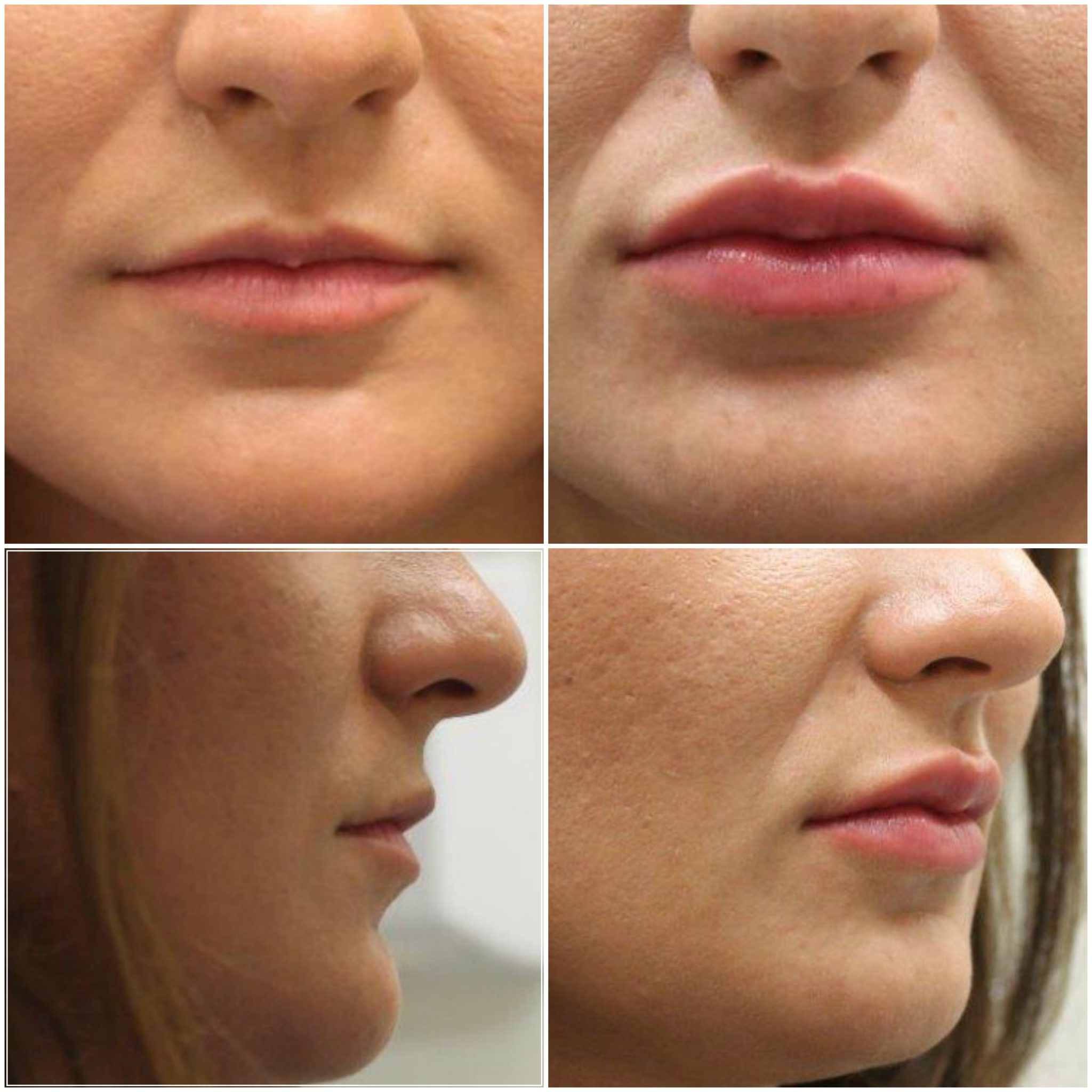 Lip Fillers London, Birmingham, Manchester, Bristol, Leeds, Glasgow