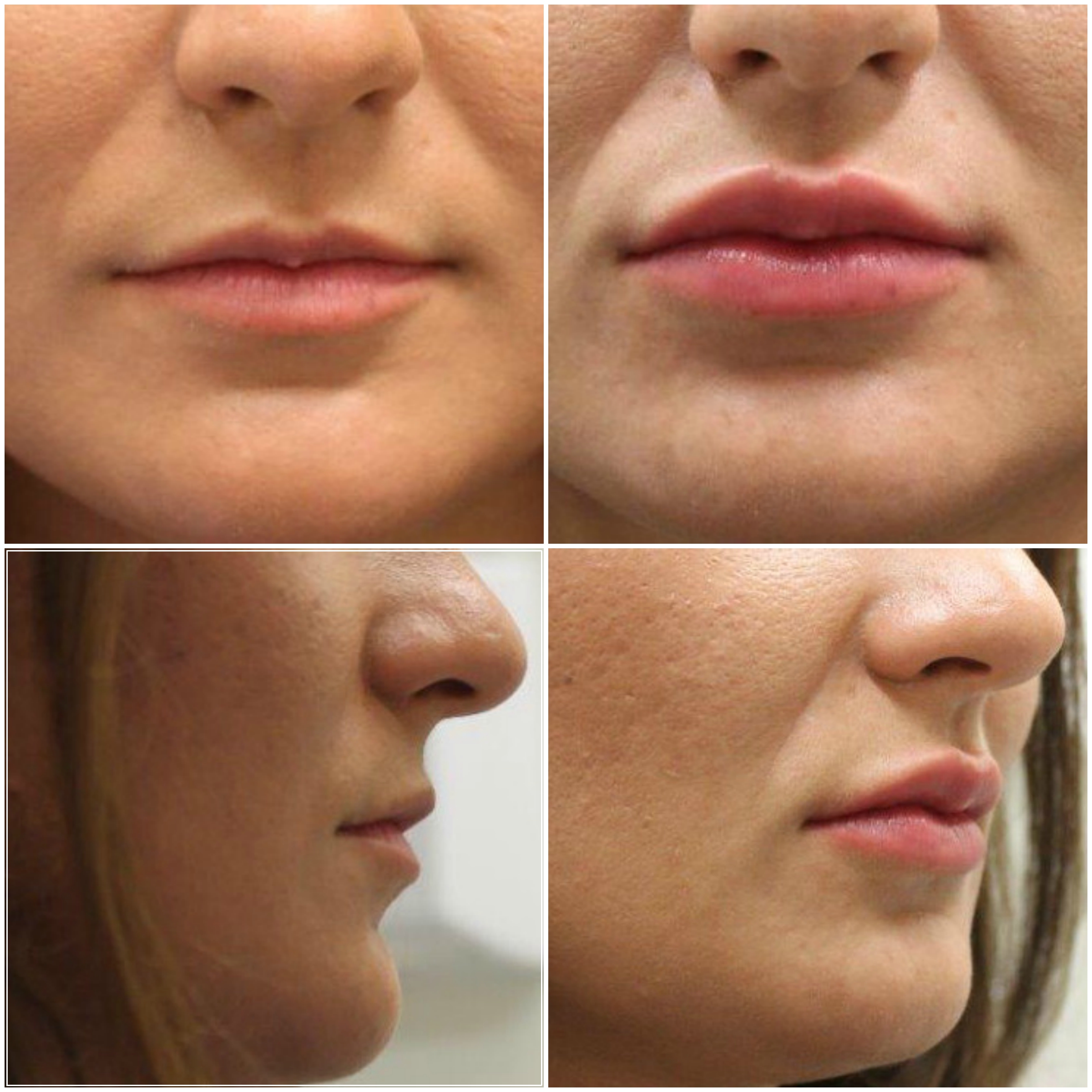 Lip Fillers London Birmingham Manchester Bristol Leeds Glasgow