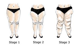 Lipoedema stages 1-3 out of five.