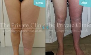 Before and after MicroLipo treatment for Lymphoedema. 