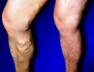 varicose vein treatment before after photos