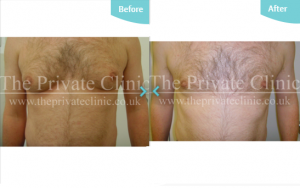 Male Chest Gynecomastia reduction results microlipo