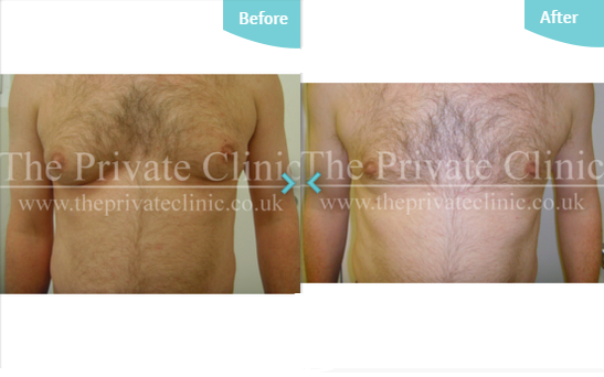 Before and after MicroLipo treatment on the male chest. 